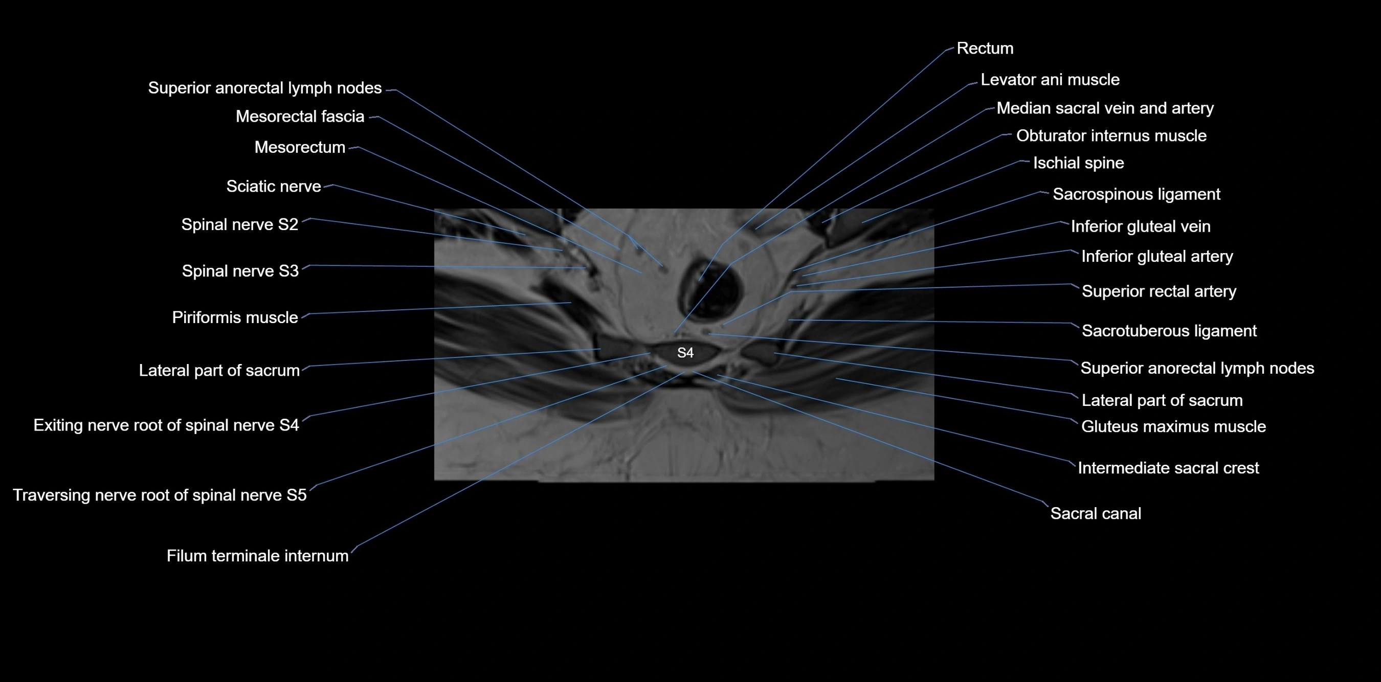 MRI sacrum, coccyx and sacroiliac joint axial cross sectional anatomy 3T  radiology  image-img-00001-00052.webp
